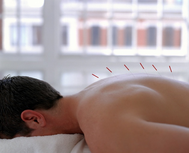 man receiving treatment with acupuncture